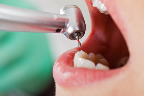 Best Emergency Wisdom Teeth Removal in Steelevle, IL